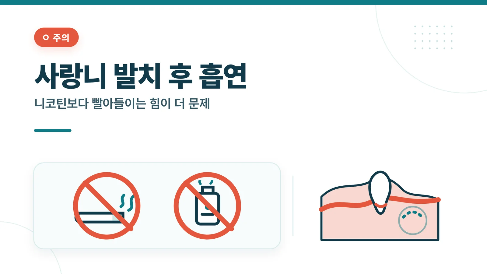 사랑니 발치 후 흡연